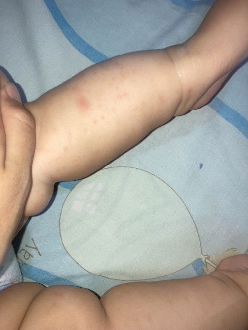 Tangan dan kaki bayi bentol merah