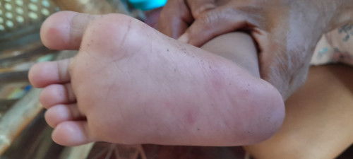 Flu Singapura,, bintik merah,, bentol,,