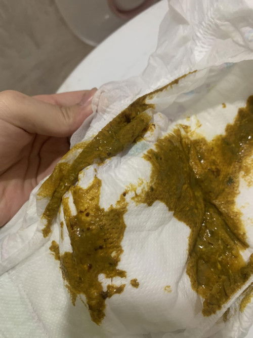 Xin ý kiến các mom ạ. Bé nhà e đi phân như này có sao khong ạ bé 3m ạ