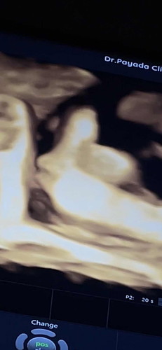 36+5 วีค กำหนดคลอด 13 ธันวาคม