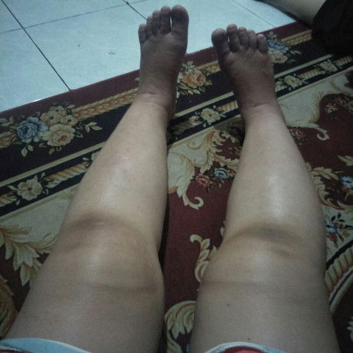 37 minggu kaki bengkak dari paha sampai telapak kaki