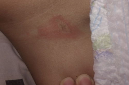 Maaf bun mau tanya, kira" ini knp y ? Apkh krn popoknya sdh kekecilan/gmn? Salep ap yg bgs bun?thx y