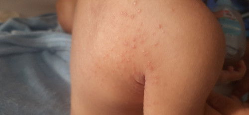 Ruam pada bayi 9 bulan