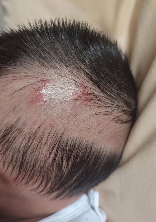 kepala anak naik ruam jerawat