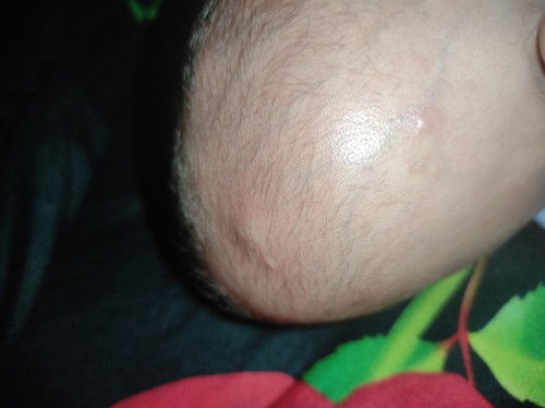 Bentol bentol di kepala