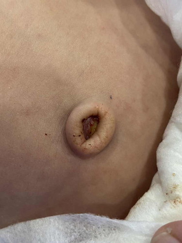 สีแดงด้านในใช่ติ่งเนื้อมั้ยคะ