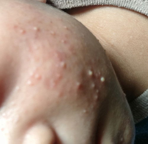 Jerawat anak katanya