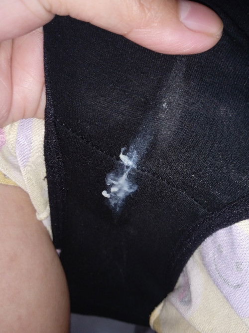 Yeast infection discharge