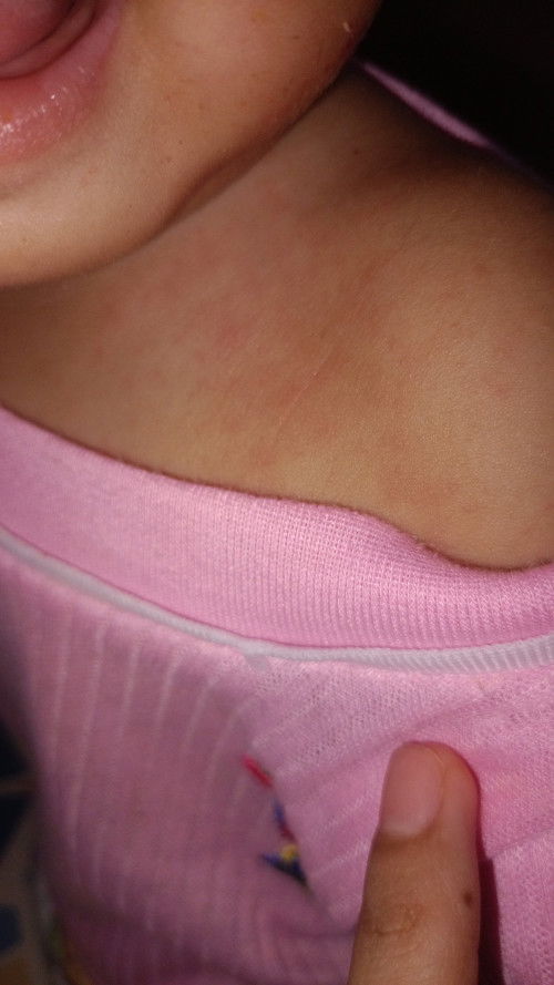 Biang keringat pada bayi