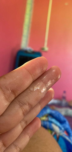 กำหยดคลอด 22  พ.ย   39+6