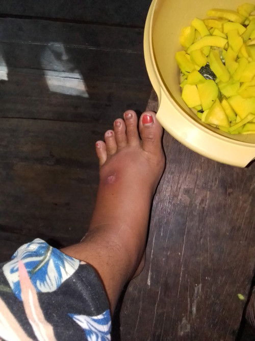 SUGAT NA MATAGAL HUMILOM