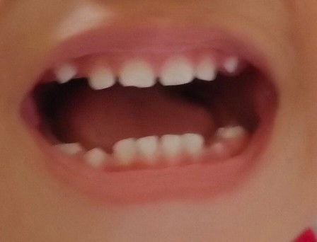 Itim sa gilagid ni baby nasa likod ng ngipin sa baba. Nababahala po ako, mii. Ano kaya yun 😢.