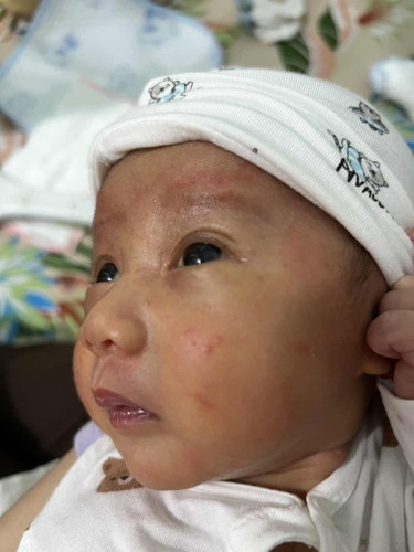 Con e bị mụn ntn ở mặt là bị sao v ạ. Có phải bị tràm sữa khoing các mom. Bội gì cho hết ạ, e lo qua