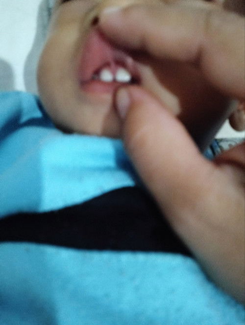 Mau tanya bun, ini lip tie bukan ya? 
Anak saya hpl Januari 2023 punya kesulitan menyusu