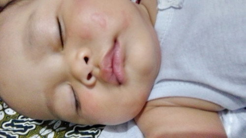 Bayi gatal2