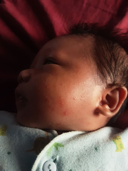 Bintik bintik bayi 1 bulan