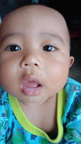 สีขาวที่ปากเกิดจากอะไรคะ