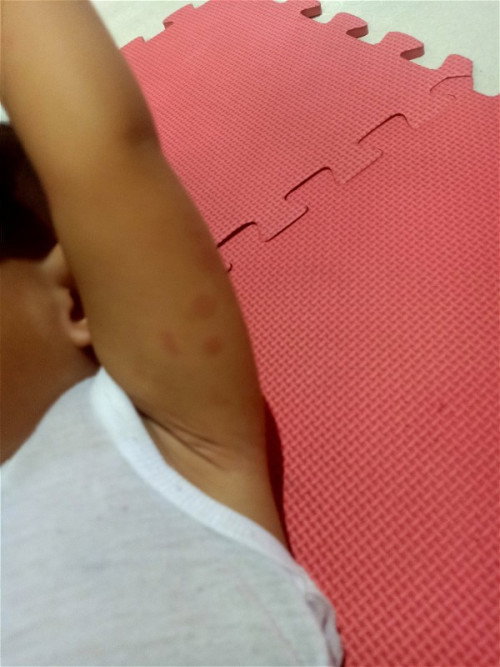 Allergy po ba?