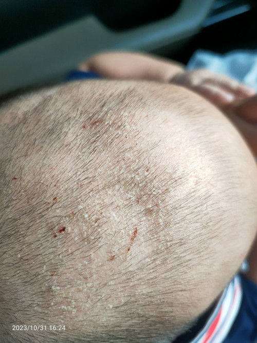 หนังศรีษะเด็ก