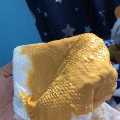 น้อง5เดือนถ่ายแบบนี้ปกติมั้ยค่ะไม่ถ่ายมา2วันพึ่งมาถ่ายวันนี้ตอนเที่ยงค่ะ นมแม่ล้วนค่ะ