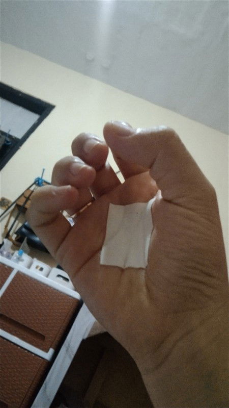 Tangan sakit tidak bisa di kepal sempurna