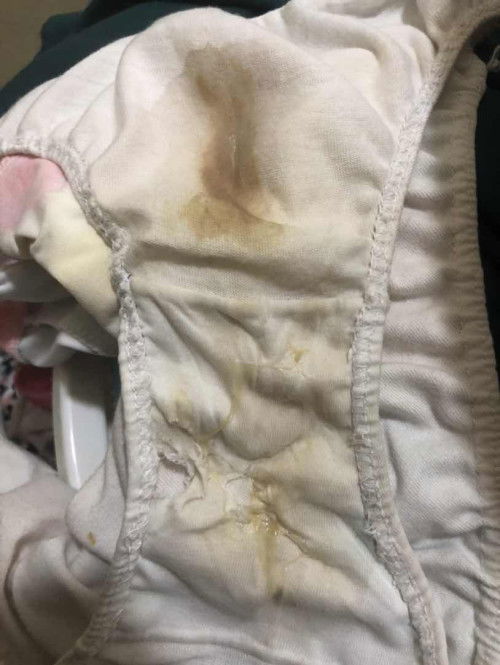 Bloody Discharge & Mucus Like discahrge