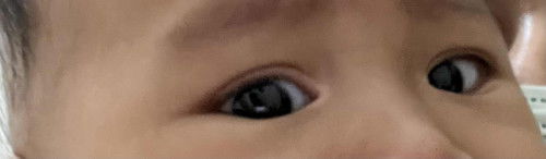 Bercak putih di pokok kelopak mata