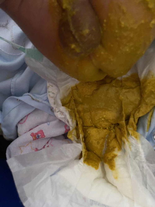 น้องได้28 วันถ่ายเหลว