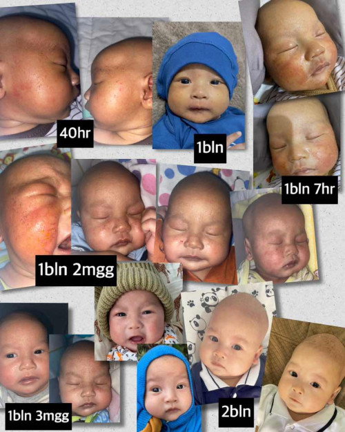 Perjuangan ruam parah dipipi newborn
