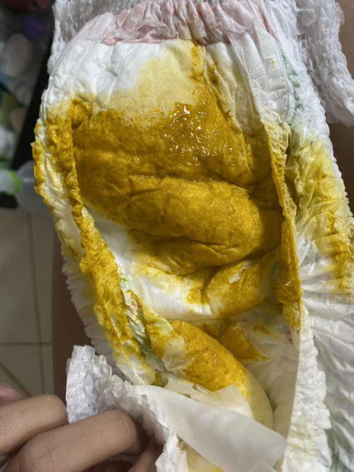 อึแบบไหนบ่งบอกว่าลูกท้องเสีย