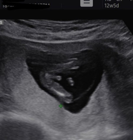 NT SCAN (ini Jantina baby ke ??)