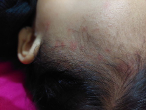 Bintik merah di kepala bayi. Obatnya apa