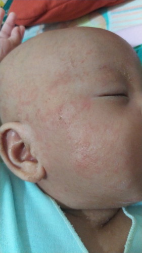 Obat kulit bruntusan bayi