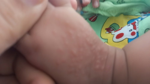 Bé bị nổi như vầy là bị gì hả các mom