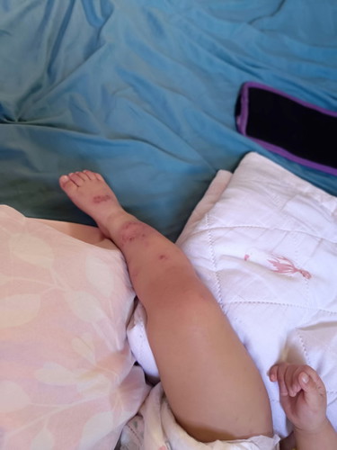 HAND, FOOT, AND MOUTH DISEASE