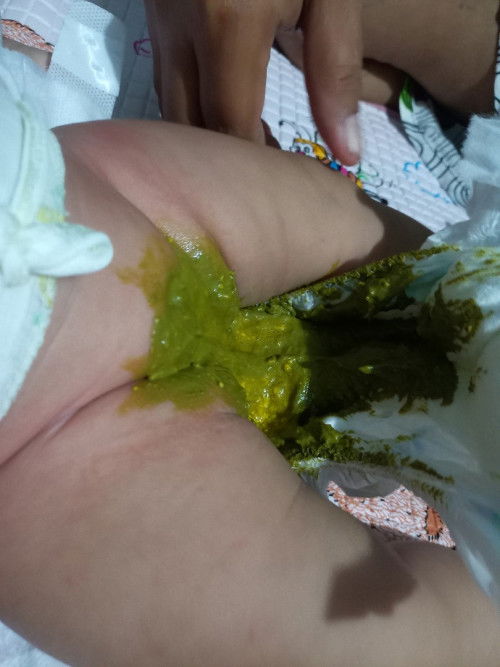 Feses bayi 2 bulan warna hijau semenjak pake vidoran