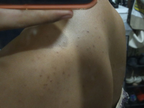 normal ba magka back acne