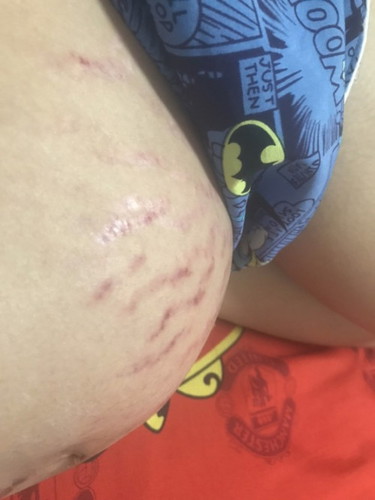 บ้านนี้ท้องแตกหนักมาก ครีมตัวไหนก็เอาไม่อยู่ หลังคลอดจะรักษาหายดีไหม