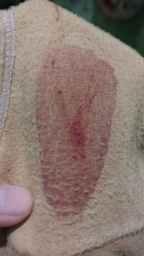 Mom flek seperti ini bahaya ga ya