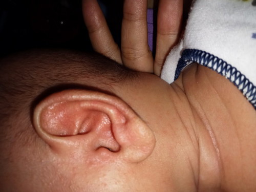 Bun ada yg pernah mengalami tdk telinga bayi saya seperti ruam trus agak kasar, itu knp ya Bun?