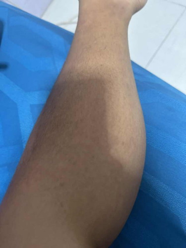 สอบถามแม่ๆ ใครเคยเป็นบ้างตอนท้อง