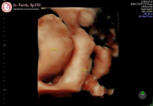 29 w janin masih sungsang