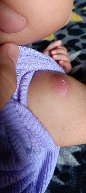 Bekas suntik bcg dibahu