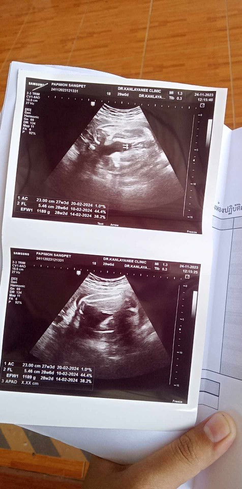 สอบถามอัลตร้าซาวด์เพศ