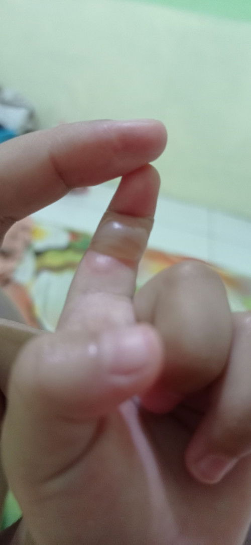 Luka Bakar pada bayi