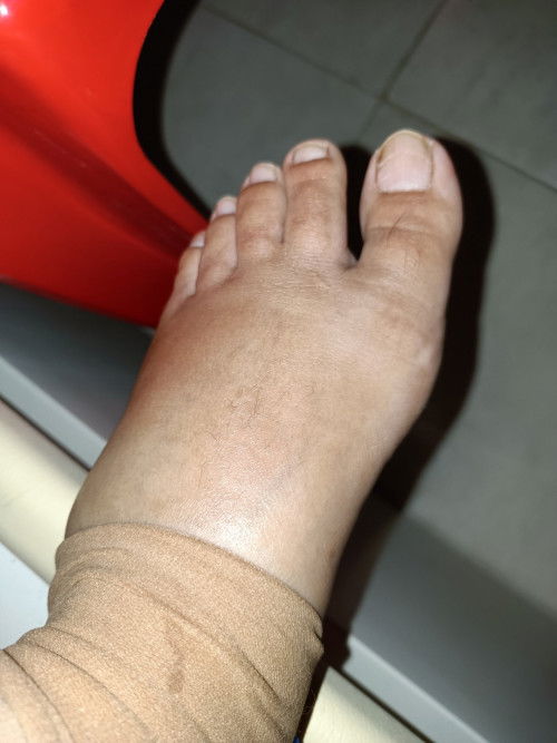 Bengkak kaki lepas bersalin Czer