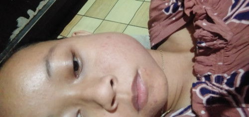 Pengen tanya apa ada yang sama kaya saya pipi bengkak saat hamil muda