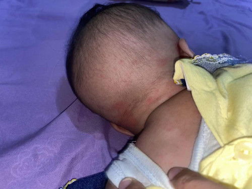 Merah merah atau biang kringat ?