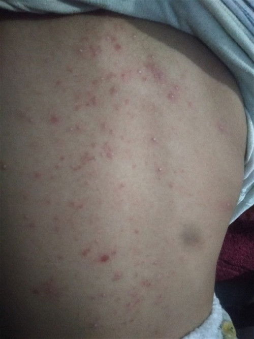 Muncul beruntusan dipunggung anak usia 2th