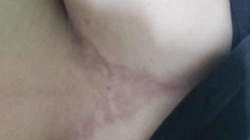 Rash or dry skin on cleavage during pregnancy